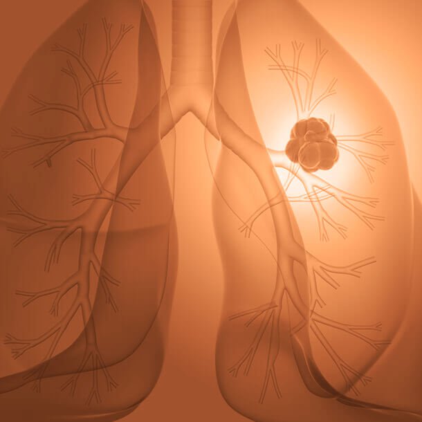 How to spot the signs of lung cancer