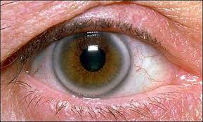 high cholesterol symptoms eyes