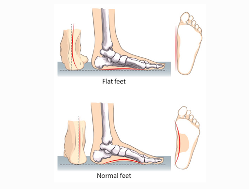 Overview of flat foot - News Nit